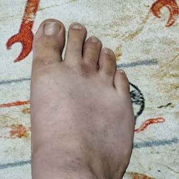 Ayak Sağlığını Bozan Terlik Üzerine İade Talebi