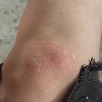 Açık Mazgal Kapağı Nedeniyle Yaya Düşmesi Ve Yaralanma