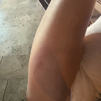 Açık Mazgal Kapağı Nedeniyle Yaya Düşmesi Ve Yaralanma