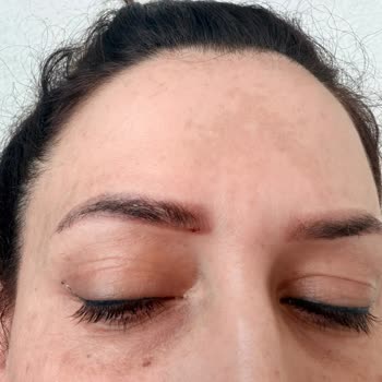 Yanıltıcı Tek Seans Sözü Ve Sağlık Sorunları Nedeniyle İade İstiyorum