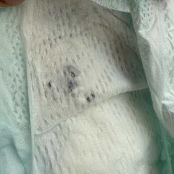 Prima Premium Care 2 Numaralı Bebek Bezinde Siyah Lekeler: Hijyen Ve Sağlık Endişesi