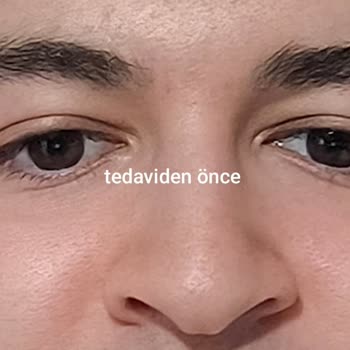 Doktorun Söz Verdiği İyileşme Gerçekleşmedi Yüzümde Kalıcı Yanık Ve İz
