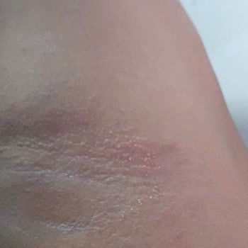 Jagler Deodorant Kullanımından Kaynaklanan Cilt Tahrişi Ve İade Talebi