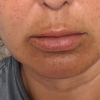 Dora Estetik Güzellik Merkezi (İstanbul) İşlem Sonrası Ağrı Ve Sonuçsuzluk
