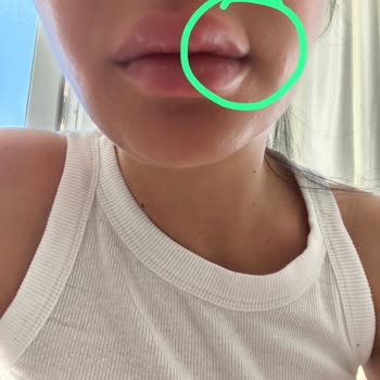 Alev Sarı Beauty Botoks İşlemim Hiç Tutmadı