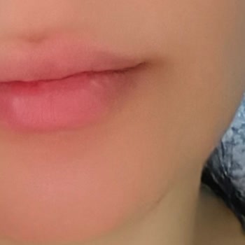 Alev Sarı Beauty Botoks İşlemim Hiç Tutmadı