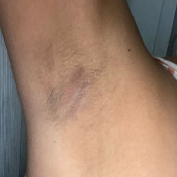 Yves Rocher Deodorantı Kullanımından Sonra Cilt Tahrişi Ve Kalıcı Leke