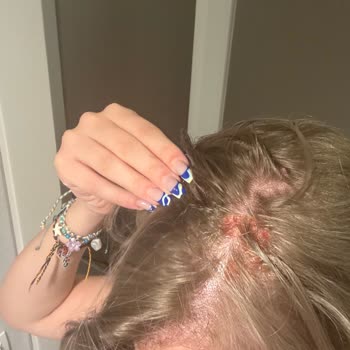 Saç Rengi Hatası Ve Kafa Derisi Yanığı Nedeniyle Aşırı Ücret Ve Mağduriyet