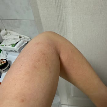 Yumoş Extra Lilyum Ve Amber Ürünlerinde Şiddetli Alerjik Reaksiyon