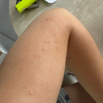 Yumoş Extra Lilyum Ve Amber Ürünlerinde Şiddetli Alerjik Reaksiyon