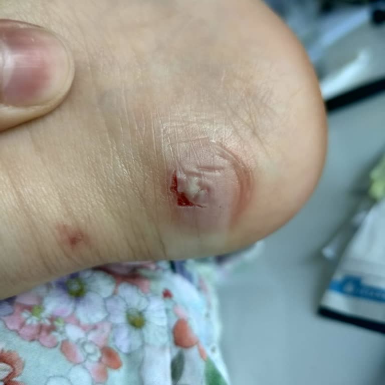 Ayakkabının Topuk Sıkışması Ve İade Talebi