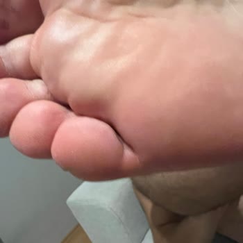 Ayak Yanması Ve Şişmeye Neden Olan Ayakkabının İadesi İçin Reddedilen Karara İtiraz