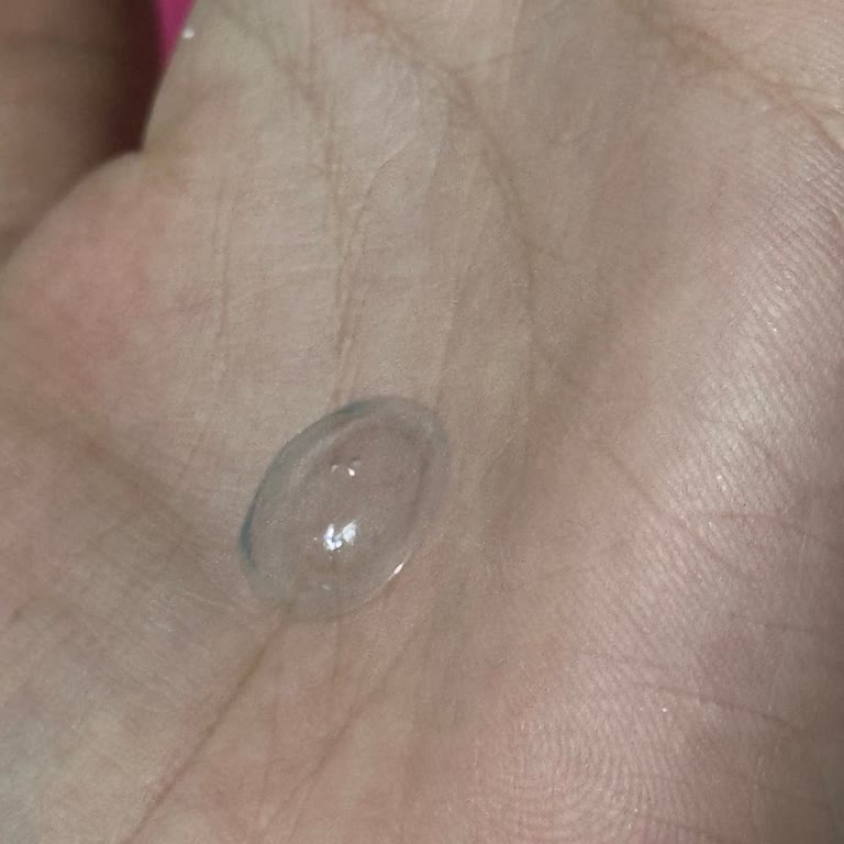 Baloncuklu Acuvue Oasys Lenslerde Göz Yanması Şikayeti