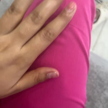Tırnak Çıkarma İşleminde Yanma Ve Kalıcı Hasar, Sağlık Ve Estetik Mağduriyeti
