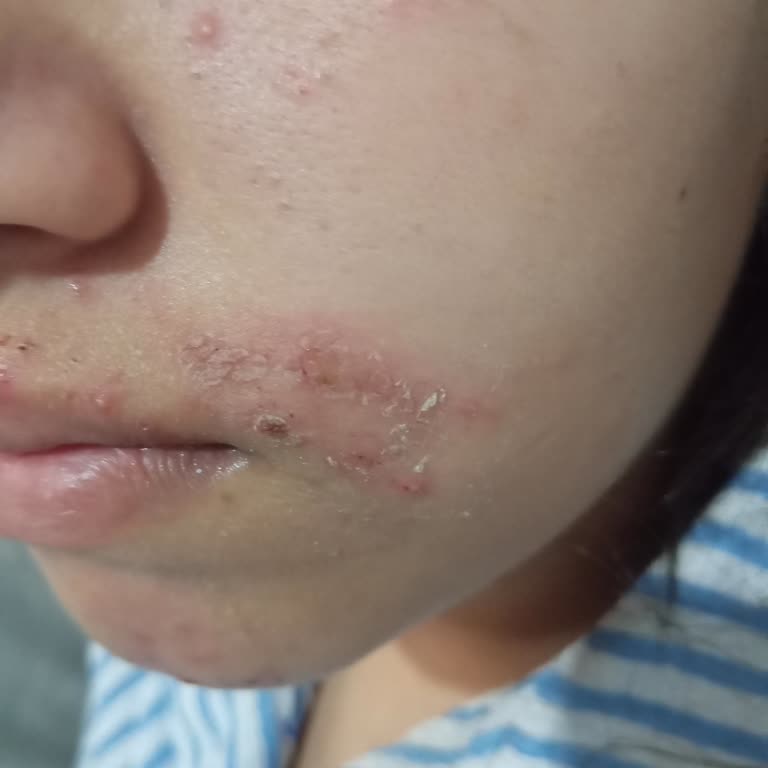 Caudalie Yüz Bakım Ürünleri Sonrası Şiddetli Sivilcelenme Ve 3500 TL Geri Ödeme İsteği