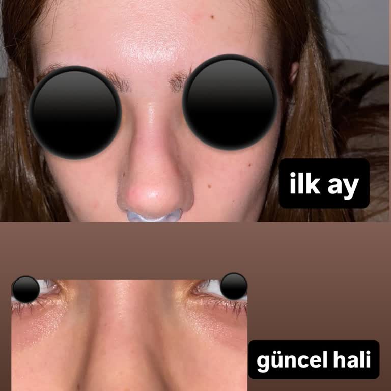 Revizyon Burun Ameliyatı Sonrası Asimetrik Görünüm Ve Büyük Hayal Kırıklığı