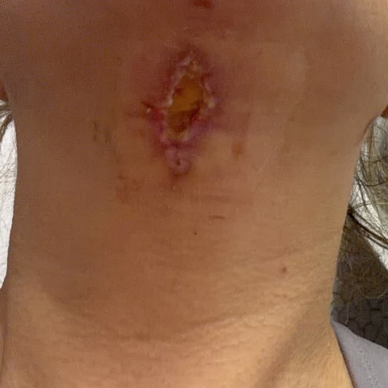 Op. Dr. Mehmet Öztan Gıdı Estetiği Sonrası Enfeksiyon Ve Doktorun İlgisizliği