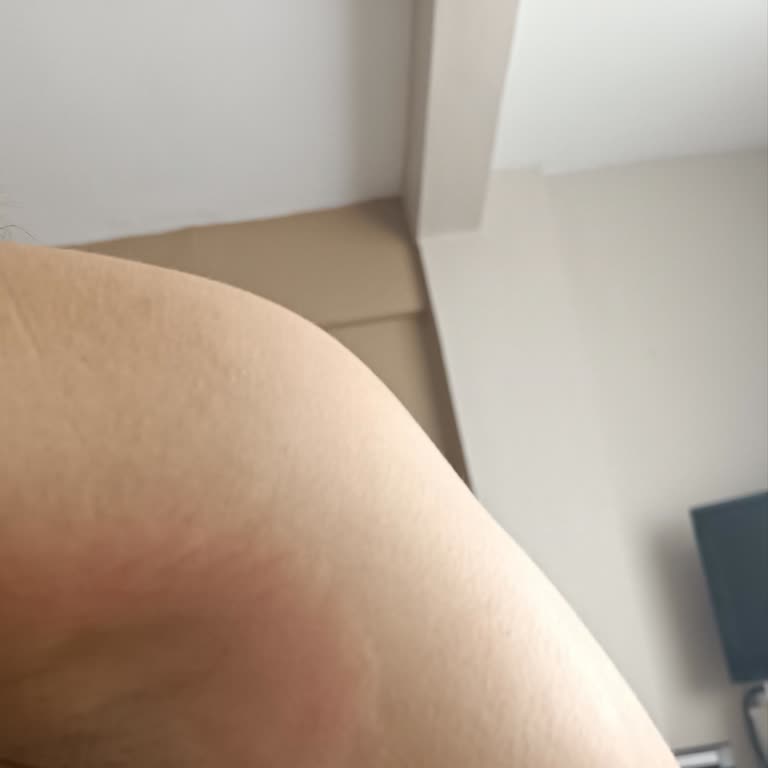 Watsons Love My Skin Deodorant Caused Severe Burning and Skin Reaction