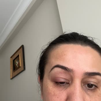 Watsons Göz Kremi Kullanımından Şiddetli Alerjik Şişlik Ve Kaşıntı