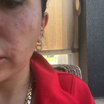 Beglab Medikal Kozmetik Yüzümde Ciddi Reaksiyonlar Oluştu