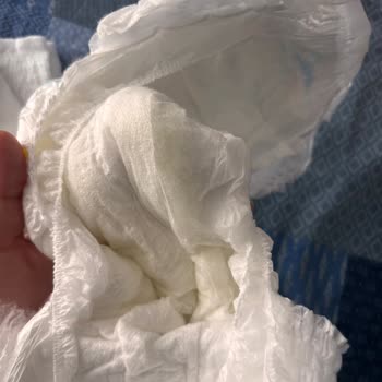 Molfix Külot Bezlerinde Polimer Sızıntısı Ve Bebek Cildi Tahrişi