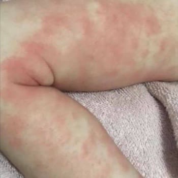 SHEIN Order 37331427210 Textiles Cause Severe Allergic Reaction in Infant and Parent