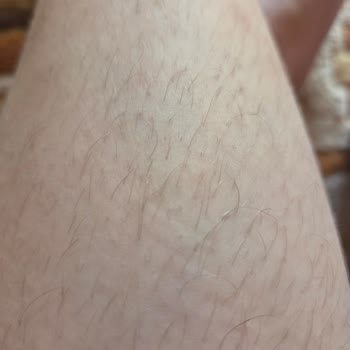 Lazer epilasyon hizmeti şikayeti ve iade talebi