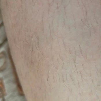 Lazer epilasyon hizmeti şikayeti ve iade talebi