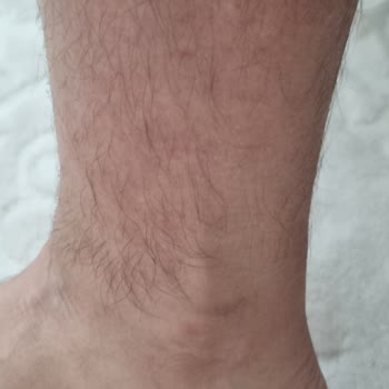 Hijyen İhlalleri Ve Böcek Sokması Sonrası Geciken İade