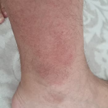 Hijyen İhlalleri Ve Böcek Sokması Sonrası Geciken İade