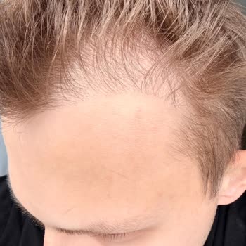 Saç Ekimi Sonrası Tıbbi Dosya Ve Faturanın Verilmemesi