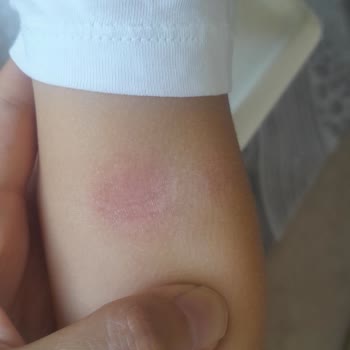 Argivit Şurubunda Çocukta Alerjik Reaksiyon Ve Kaşıntı Şikayeti