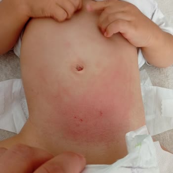 Sleepy Natural Bebek Bezinde Şiddetli Kızarıklık Ve Güven Kaybı