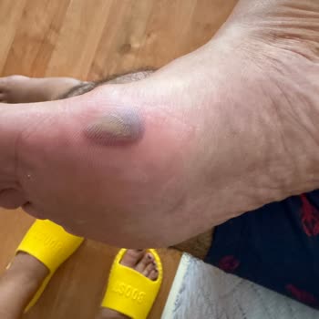 Rahatlık Garantili Sandaletin Ayağımda Şiddetli Morluk Ve Şişmeye Neden Olması Ve İade Reddi