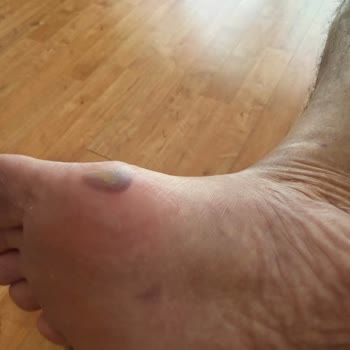 Rahatlık Garantili Sandaletin Ayağımda Şiddetli Morluk Ve Şişmeye Neden Olması Ve İade Reddi