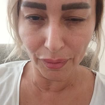 Botoks Ve Dudak Dolgusu Sonrası Göz Kapağı Düşmesi, Şiddetli Şişlik Ve Ağrı İçin Ücret İadesi Ve Özür Talebi