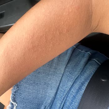 Maruderm Bronzlaştırıcı Yağ Kullanımından Sonra Şiddetli Cilt Reaksiyonu Ve Tatil Bozulması