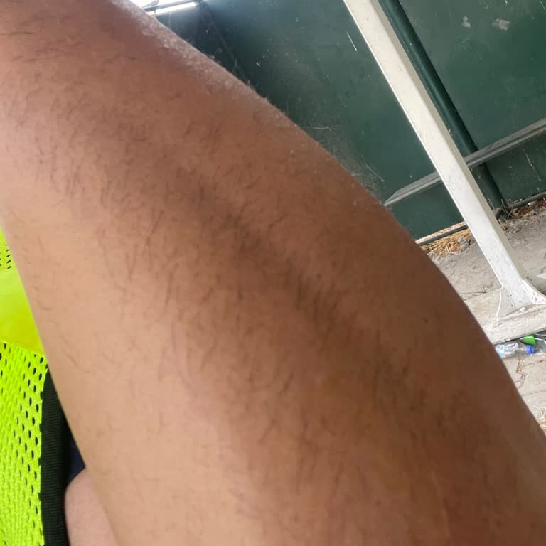 Lazer Epilasyon Söz Verilen Sonuç Vermedi, Geri Ödeme Almadığım İçin Mağdur Oldum
