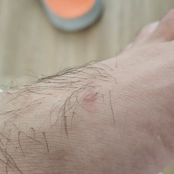 Skechers Terliğinde Şiddetli Ayak Tahrişi Ve Su Toplanması, İade Reddi