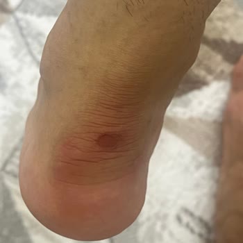 Boyner Mağazasında Yanıltıcı Bilgi Ve Ayakkabı Yaralanması Sonrası İade Reddi