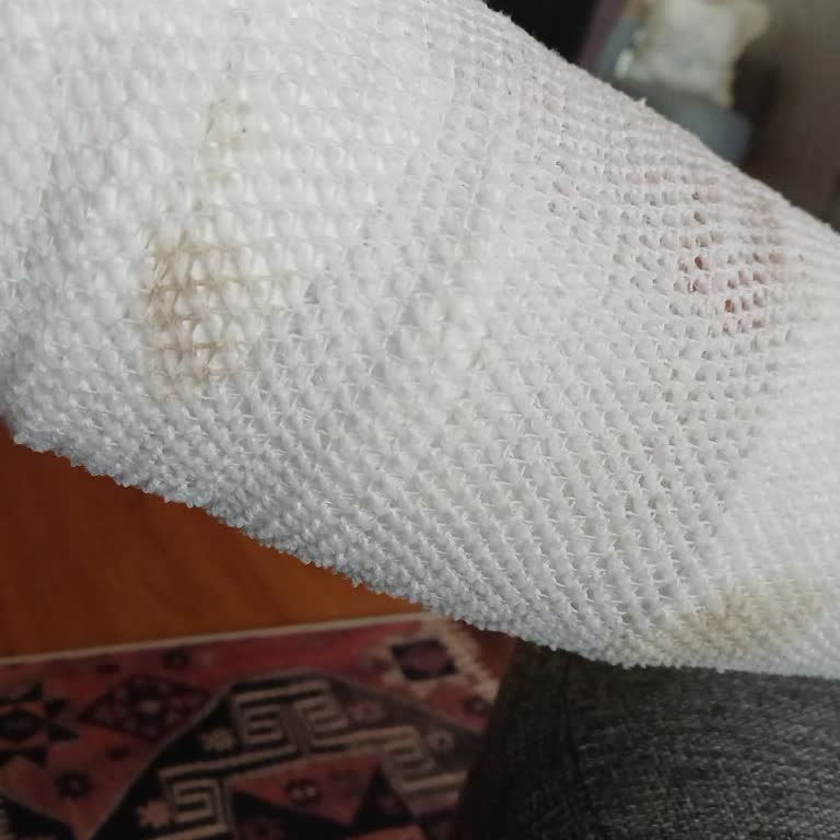 Stanley Termos Sapı Kırılması Sonrası İkinci Derece Yanık ve İş Gücü Kaybı