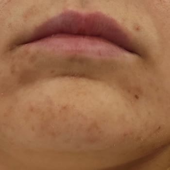 Caudalie Serumunun Ciltte Oluşturduğu Sivilce Ve Lekeler Nedeniyle İade Ve Telafi Talebi