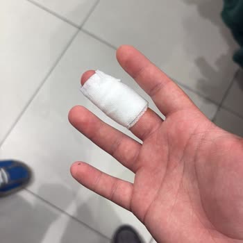 Superfresh Konserve Kapağının Açılma Zorluğu Nedeniyle Ciddi El Kesiği Ve Tazminat Talebi