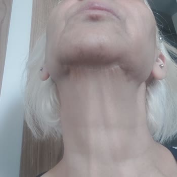 Göz Kapağı Ameliyatı Sonrası Şiddetli Göz Kuruluğu Ve Estetik Memnuniyetsizlik