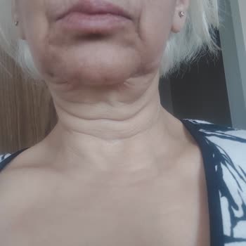 Göz Kapağı Ameliyatı Sonrası Şiddetli Göz Kuruluğu Ve Estetik Memnuniyetsizlik