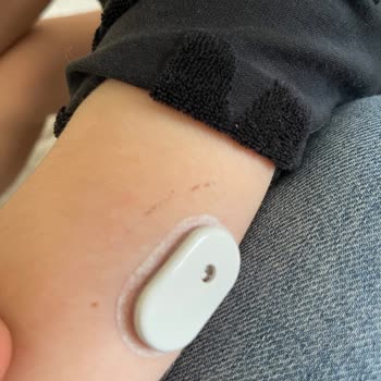 Sibionics Sensörlerinde Arıza, Kullanıcı Hatası İddiası Ve İade Talebi