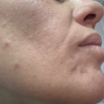 Anti-AGE Serisi Ciltte Kistik Reaksiyon Ve Mağaza Çalışanının Saygısız Davranışı
