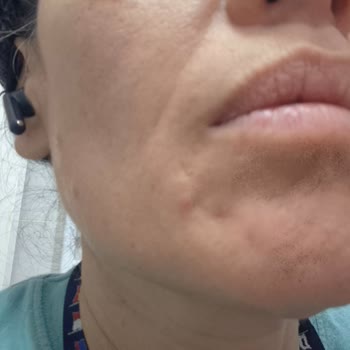 Anti-AGE Serisi Ciltte Kistik Reaksiyon Ve Mağaza Çalışanının Saygısız Davranışı
