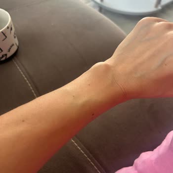 Media Markt’ta Apple Watch İade Reddi Ve Bilek Şişliği