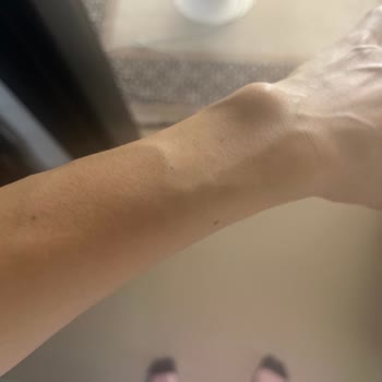 Media Markt’ta Apple Watch İade Reddi Ve Bilek Şişliği